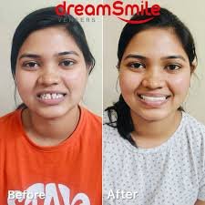 dreamsmileveneers.com