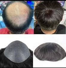 Advance Hair Transplant Clinic