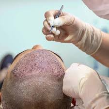 Advance Hair Transplant Clinic