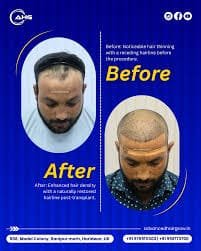 Advance Hair Transplant Clinic